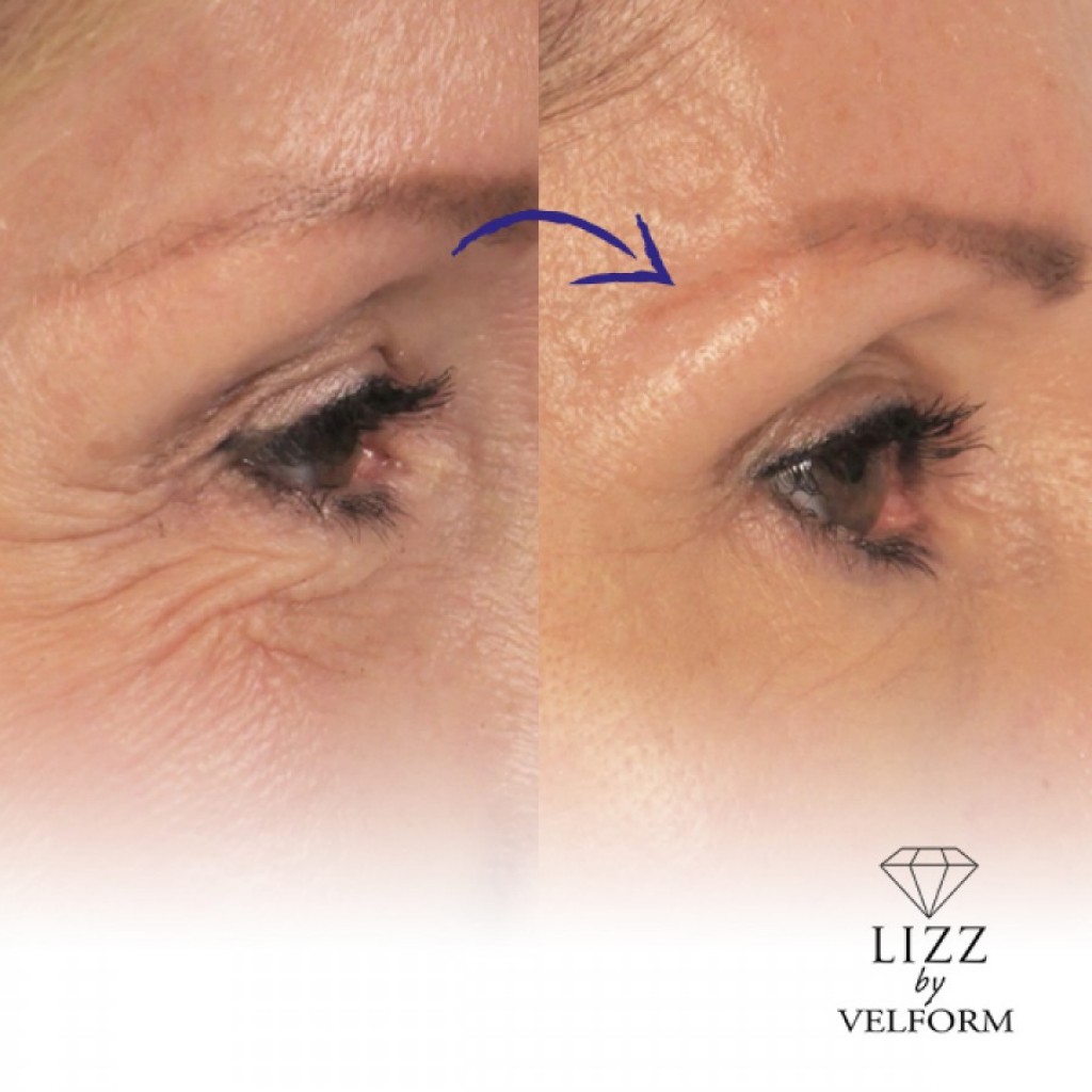 Lizz Facelift Serum