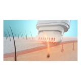 Pearl Hair Remover Systeem – Werkt dat Wel?